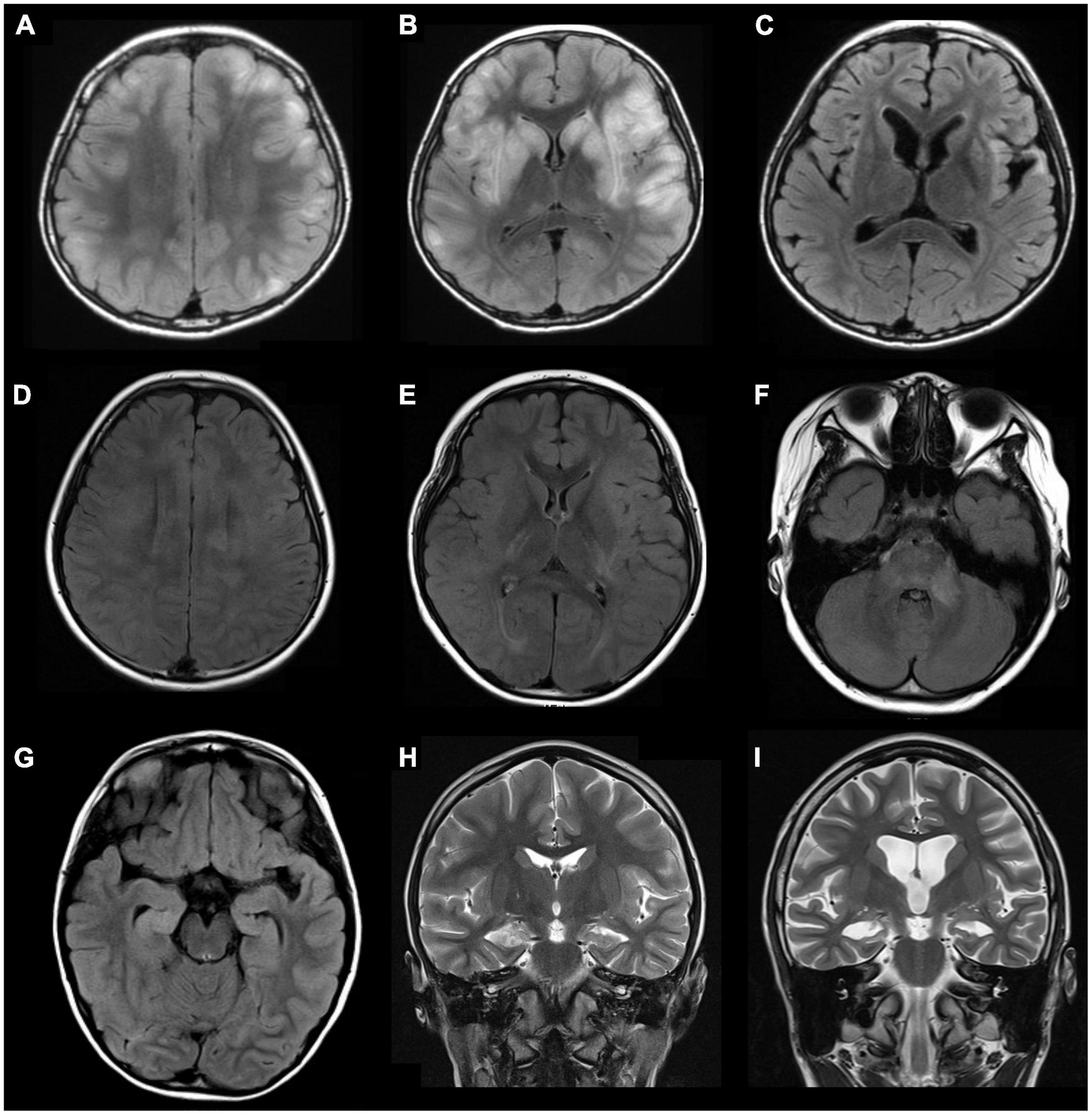 The clinical relevance of anti-glutamic acid decarboxylase antibodies in children with encephalitis/encephalopathy